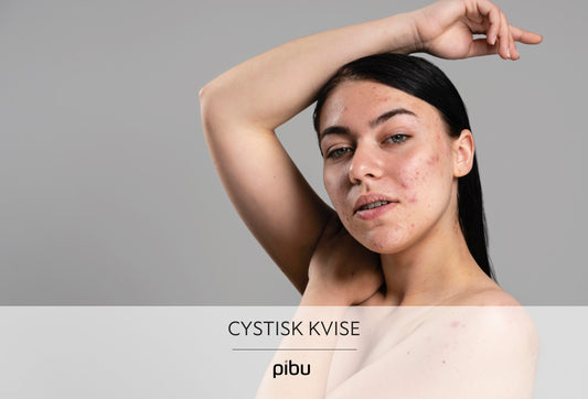 Cystisk kvise: Årsaker, symptomer, behandling og forebygging