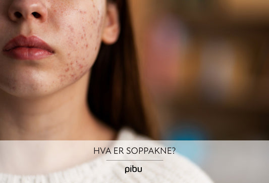 Hva er soppakne? Diagnose og behandling