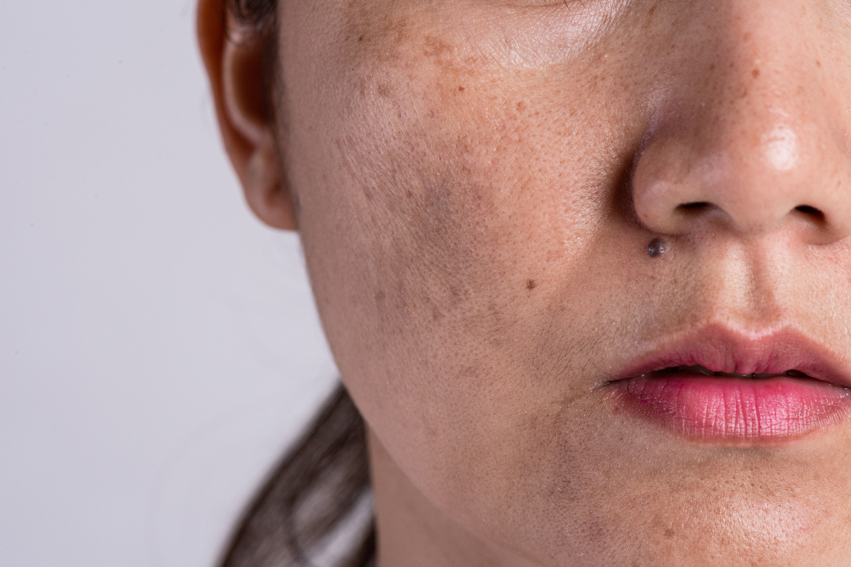 melasma Mørke flekker over leppen